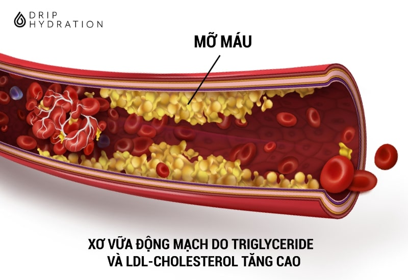 Những người có mỡ máu cao thường sẽ có chỉ số Triglycerides và Cholesterol cao đồng thời