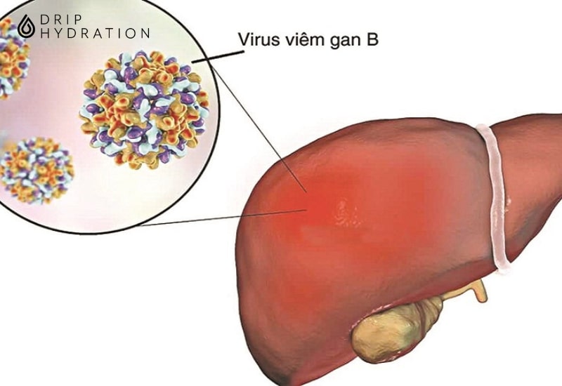 Tình trạng nhiễm virus viêm gan B dương tính hiện đang ở mức báo động đỏ tại Việt Nam