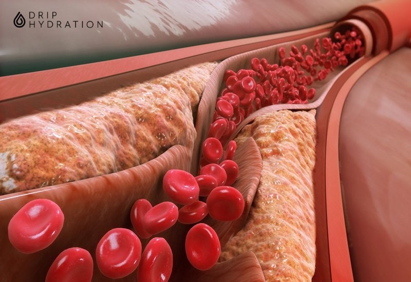 Nhóm statins được lựa chọn ưu tiên trong điều trị mỡ máu cao