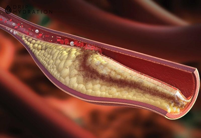 Rối loạn mỡ máu xảy ra khi mức lipid bất thường