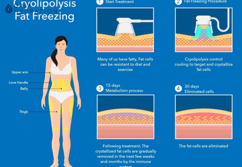 Công nghệ đông lạnh (cryolipolysis technology) giúp giảm mỡ nội tạng