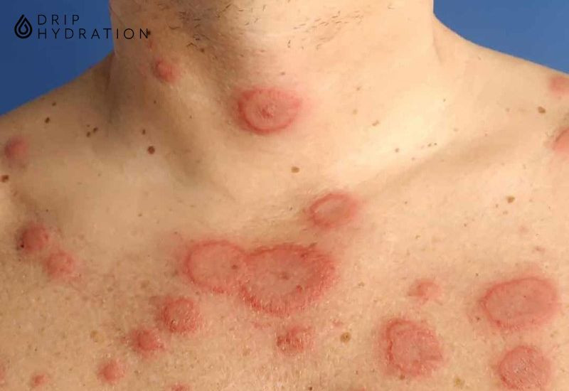 Xét nghiệm chẩn đoán lupus ban đỏ dựa trên công thức máu