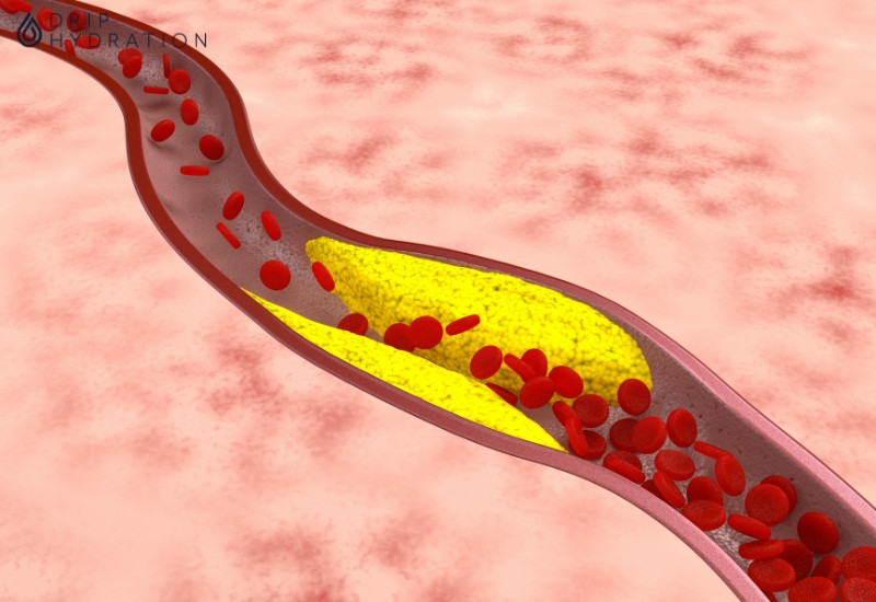 Ảnh 2: Gia tăng LDL cholesterol trong máu làm hình thành mảng xơ vữa nguy hiểm với sức khỏe