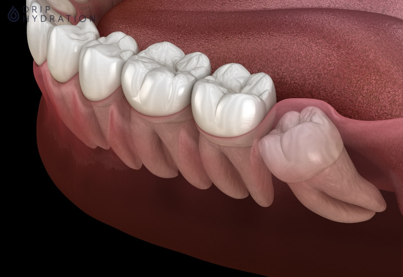 Răng khôn mọc lệch, mọc ngầm gây nhiều đau đớn cho người bệnh