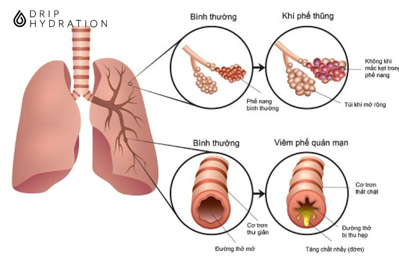 béo phì gây hậu quả gì