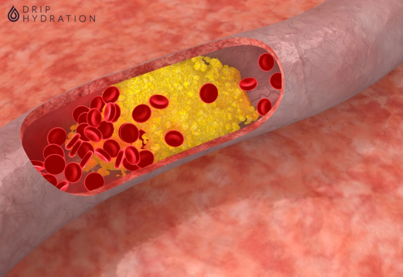 Chất béo làm tăng cholesterol toàn phần và cholesterol xấu