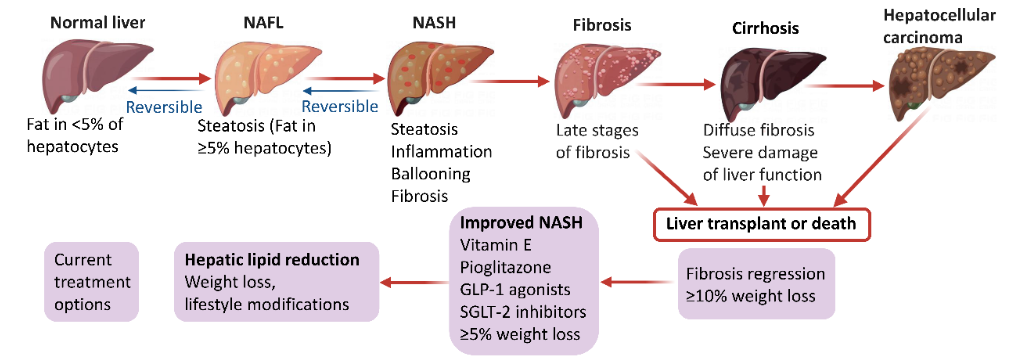 Hình 1. Các giai đoạn bệnh gan nhiễm mỡ và các phương pháp điều trị tương ứng