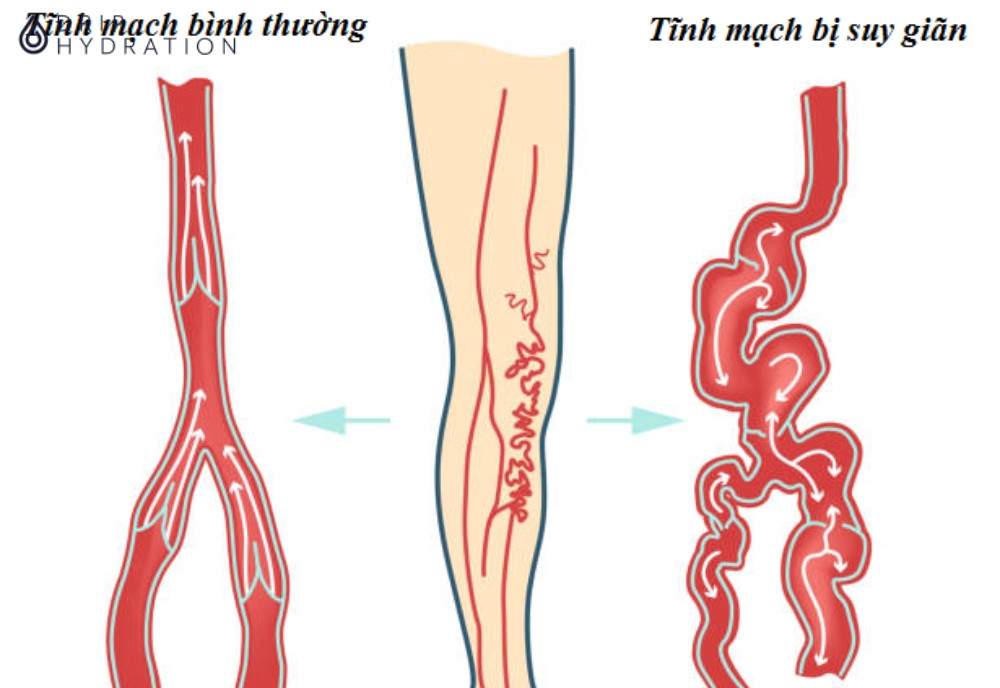 Nguyên nhân suy giãn tĩnh mạch đa dạng và có thể bắt nguồn từ nhiều yếu tố khác nhau