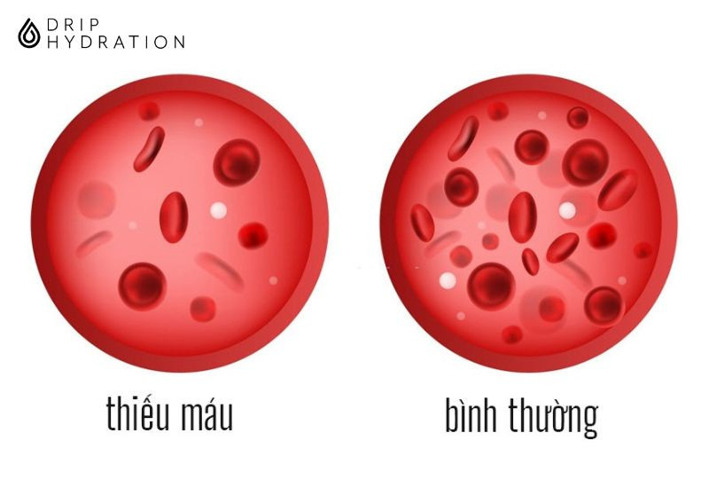 Thiếu máu