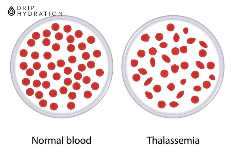 Thalassemia là gì