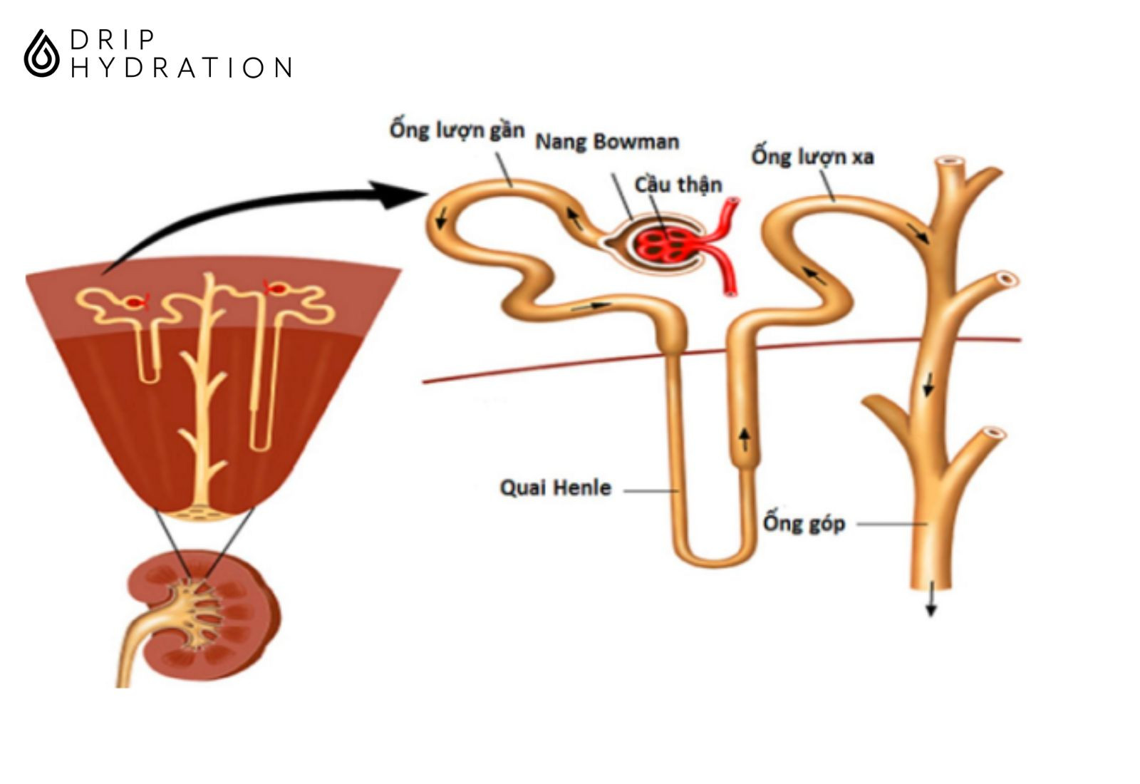 Viêm cầu thận cấp