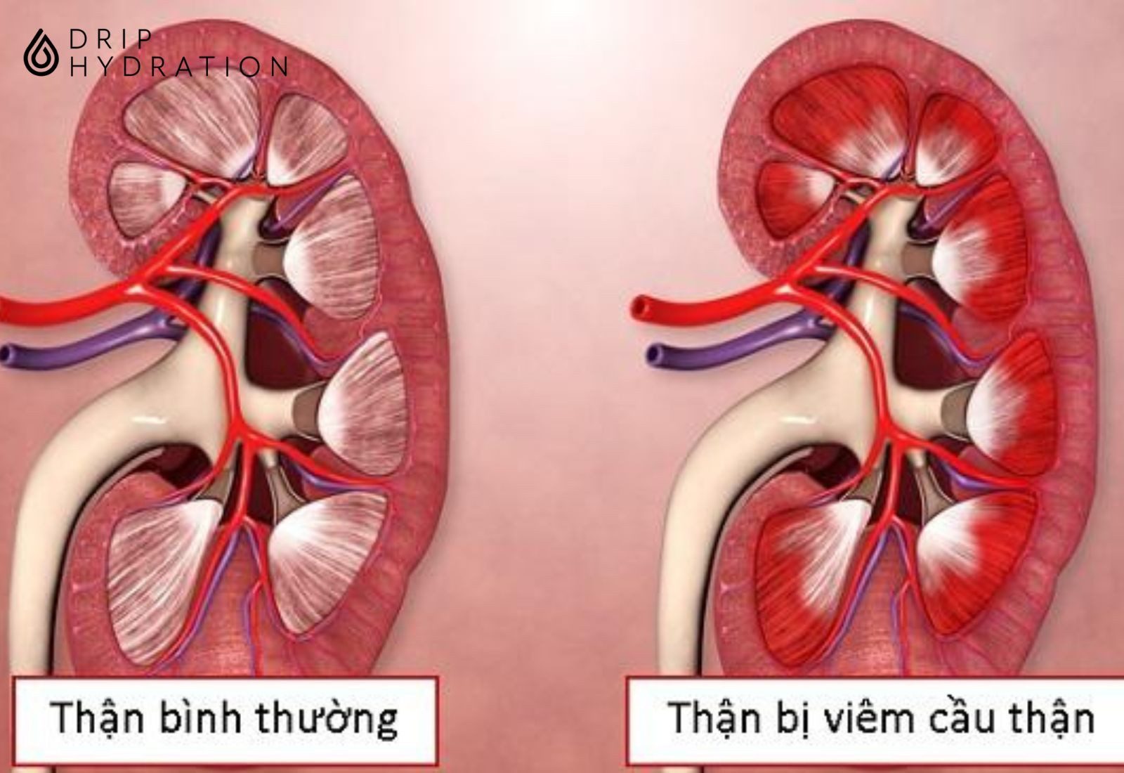 Viêm cầu thận cấp