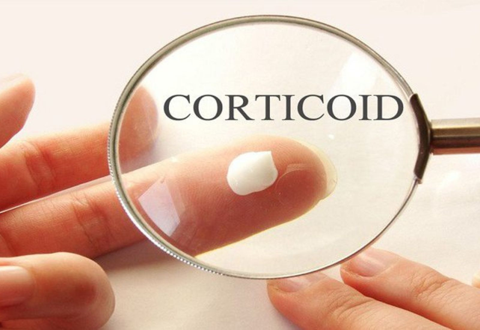 da nhiễm corticoid nặng