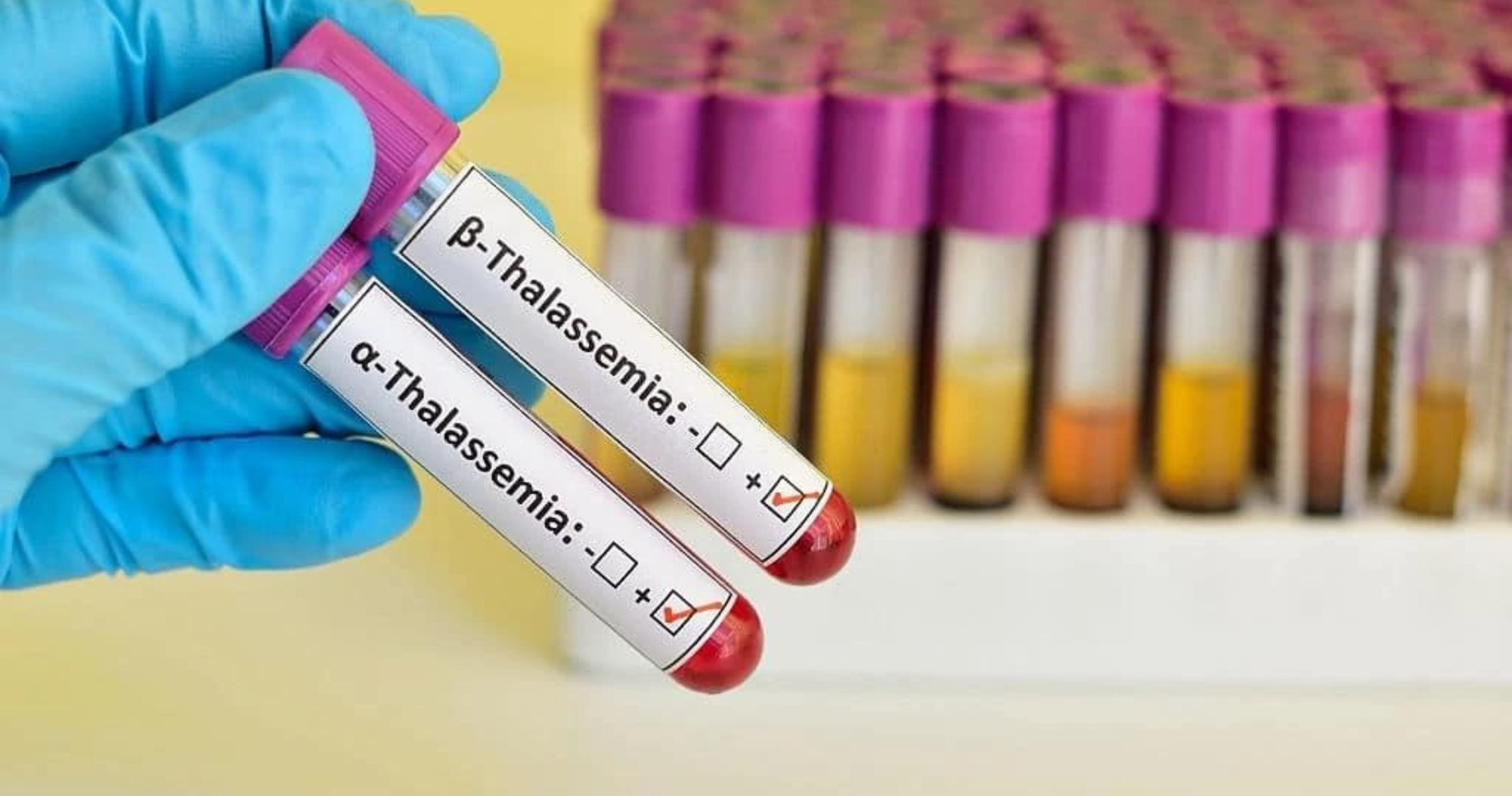 Thalassemia là gì? Các triệu chứng phổ biến và phương pháp điều trị có sẵn