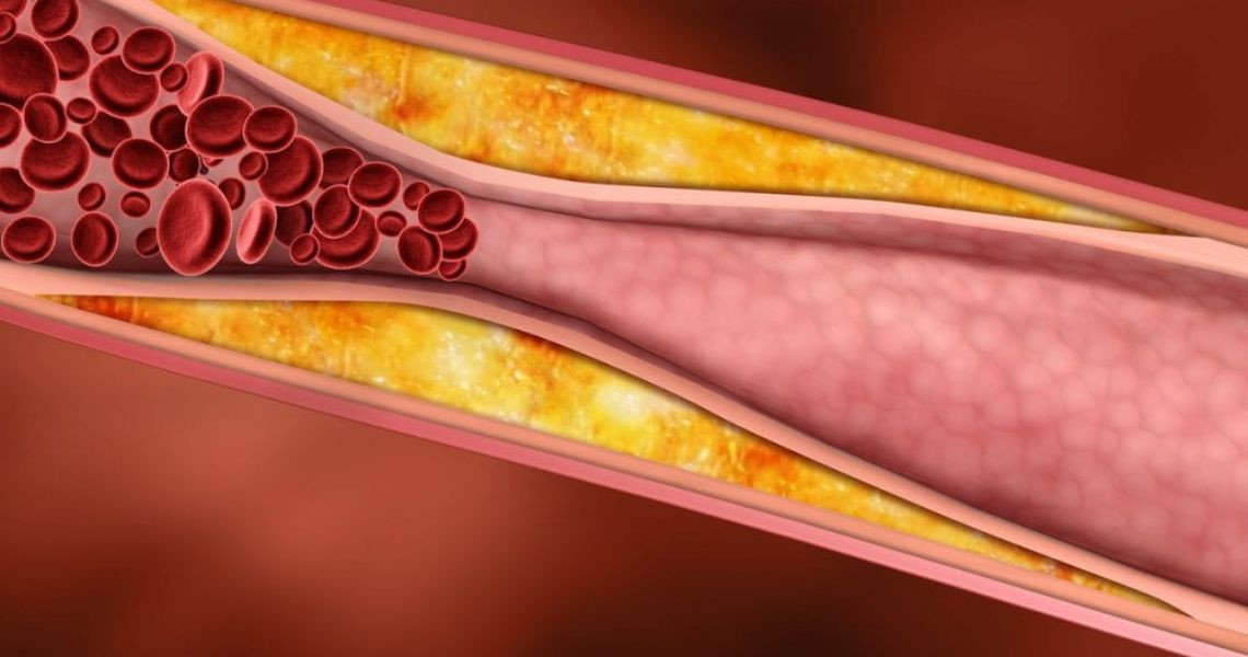 Triglyceride cao: Những điều bạn cần biết