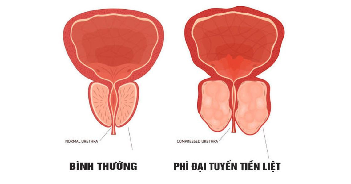 Bệnh phì đại tuyến tiền liệt có nguy hiểm không?