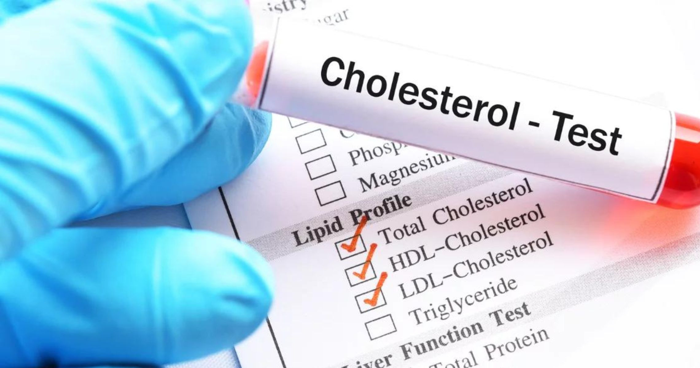 Vì sao cần xét nghiệm Cholesterol toàn phần trước khi thực hiện giảm béo?