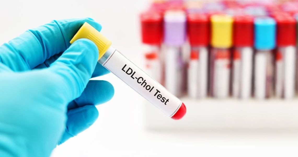 Xét nghiệm máu LDL Cholesterol là gì?