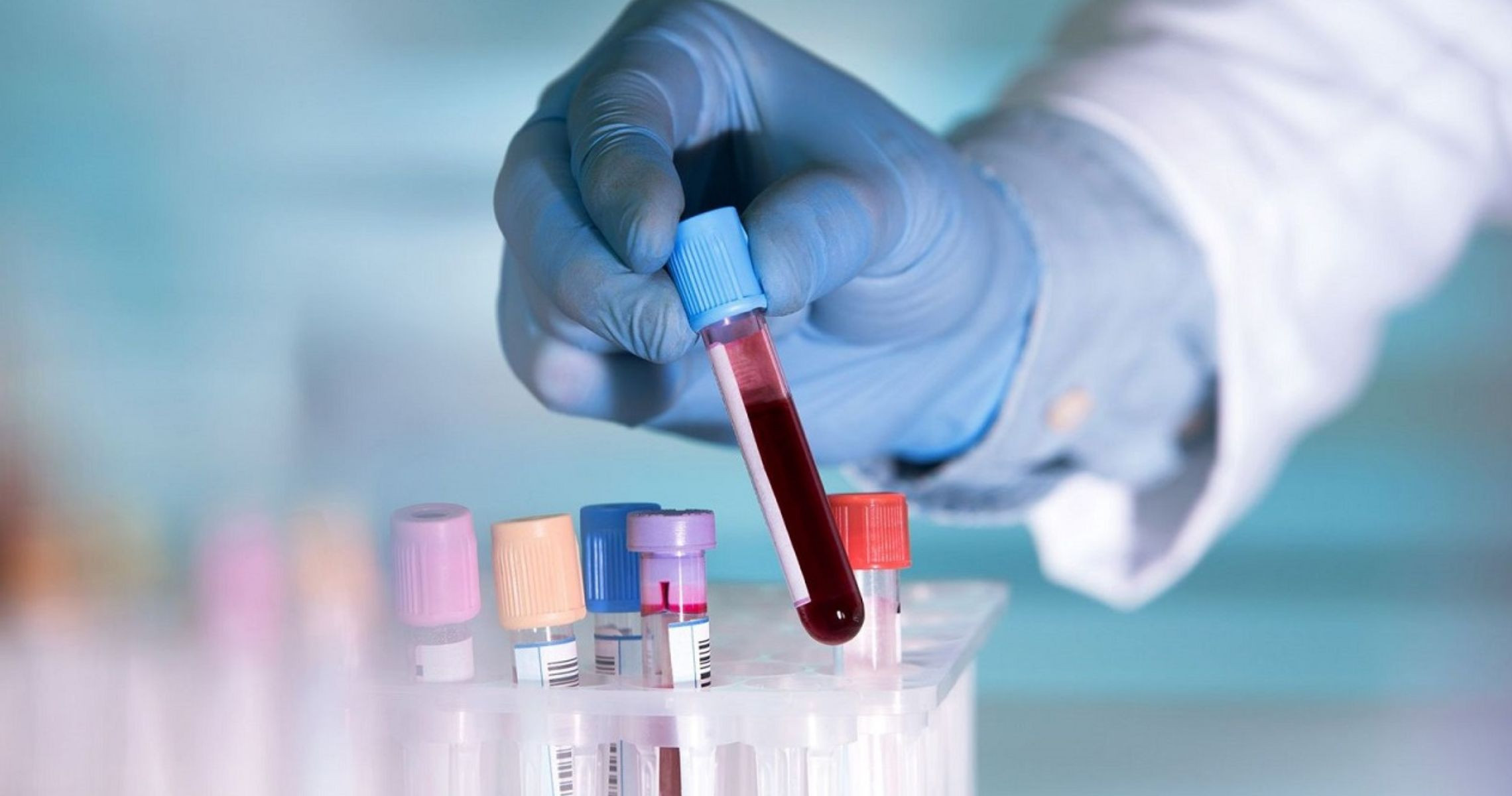 Hướng dẫn xem chỉ số thiếu máu thiếu sắt trong kết quả xét nghiệm