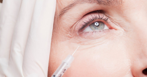 Có thể tiêm botox xóa nhăn mắt không?