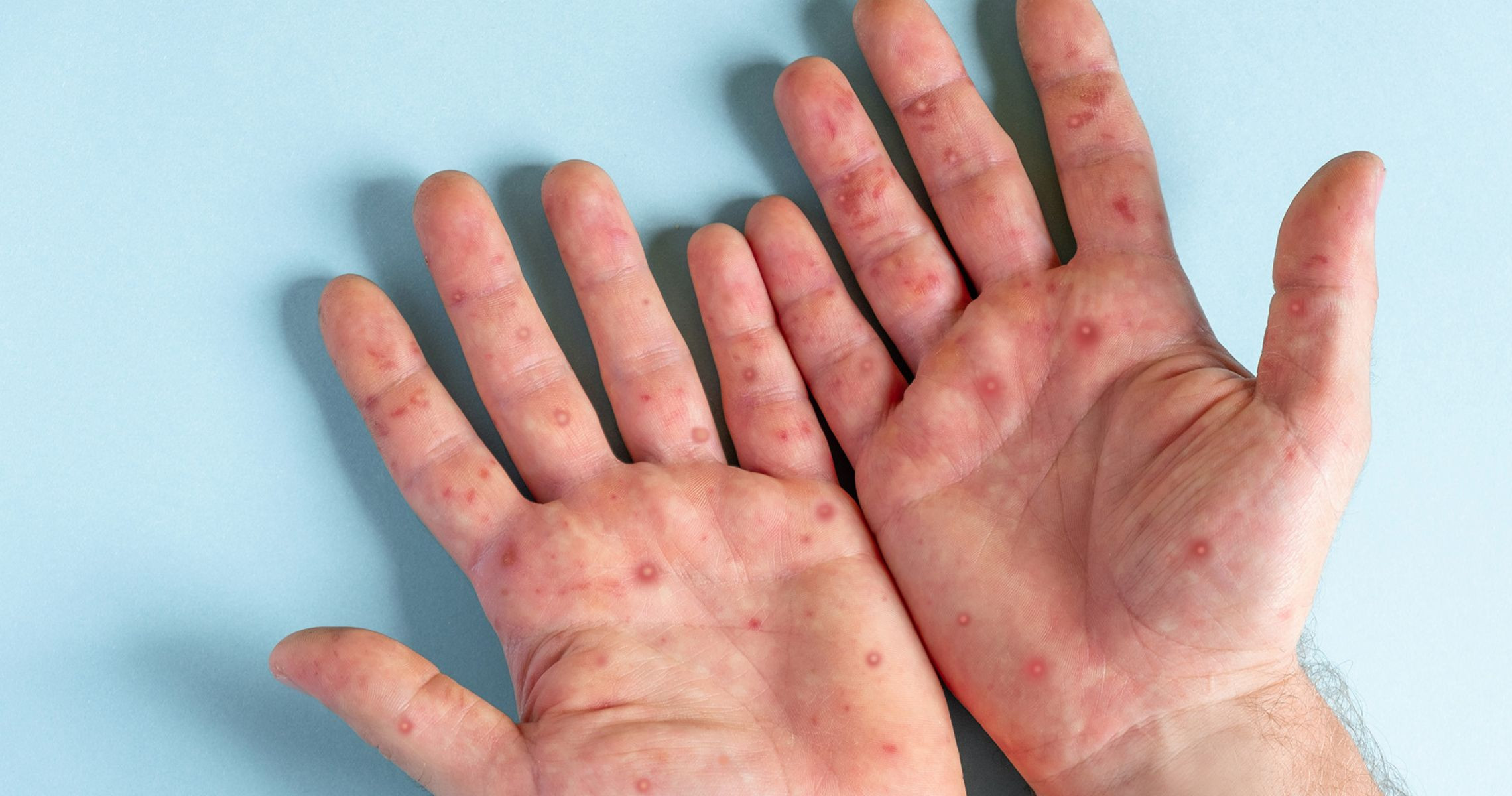 Monkeypox là gì và làm thế nào để thực hiện xét nghiệm?