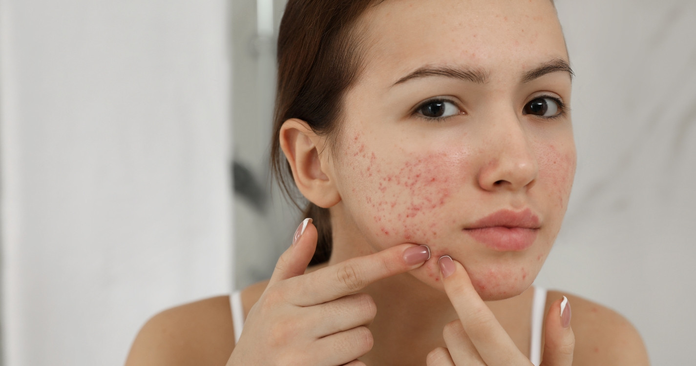 Cách chăm sóc da mặt mụn thâm