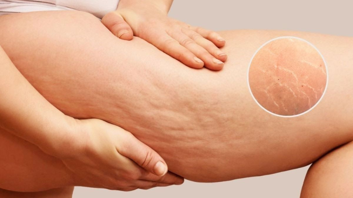 Rạn da do béo phì: Vì sao xuất hiện, cách nào để khắc phục?