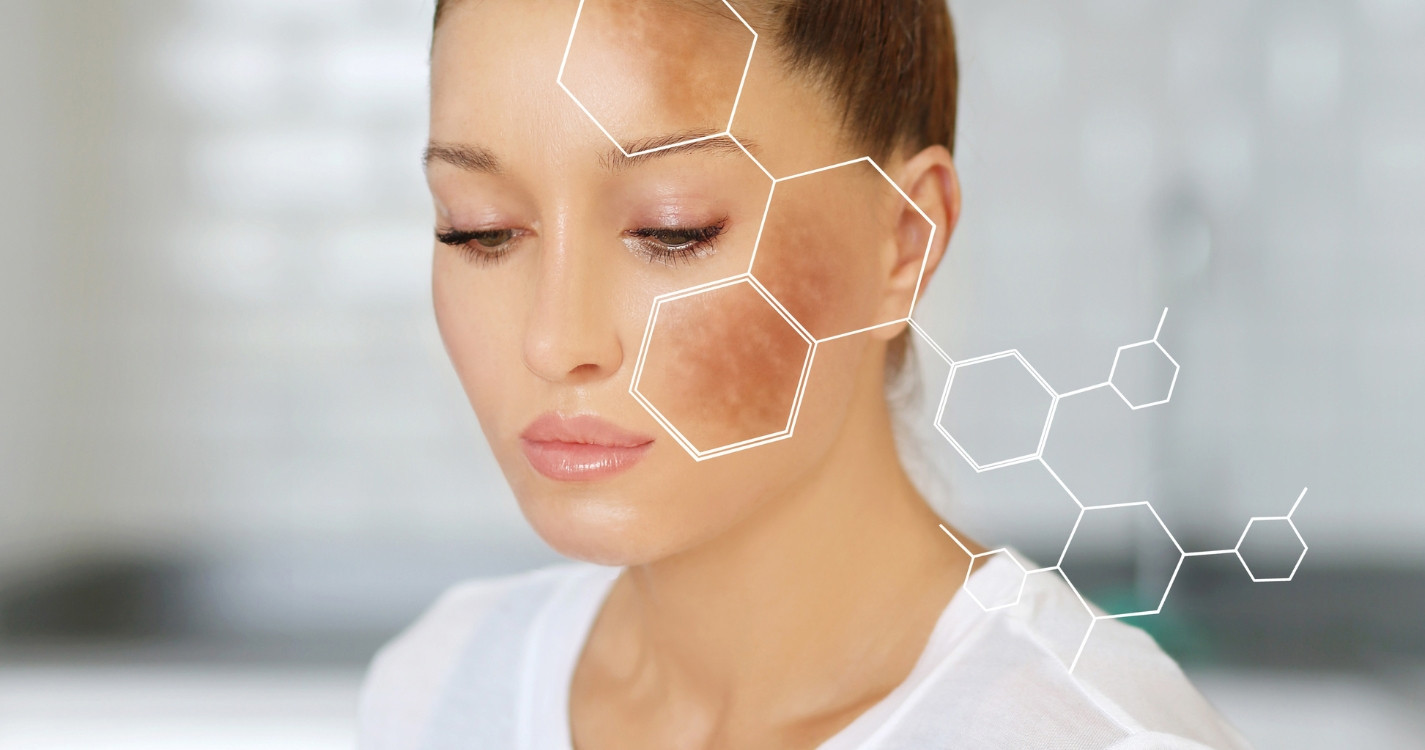 Cách chăm sóc da mặt bị nám và tàn nhang