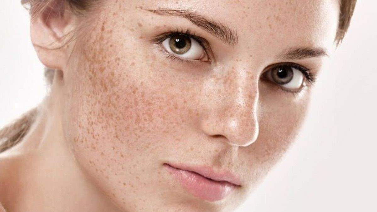 Đồi mồi là cái gì? Nguyên nhân và cách khắc phục hiệu quả