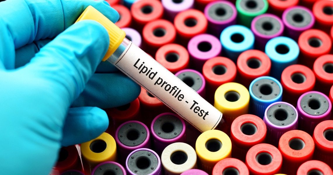 Khi nào cần thực hiện xét nghiệm máu nhiễm mỡ?