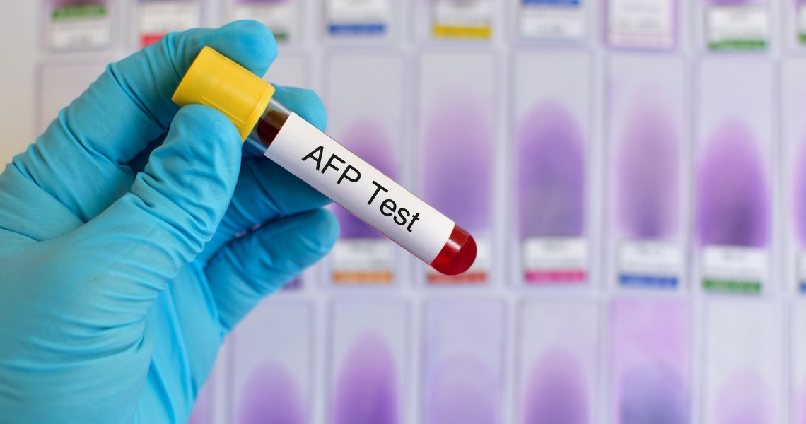 Xét nghiệm máu AFP là gì?