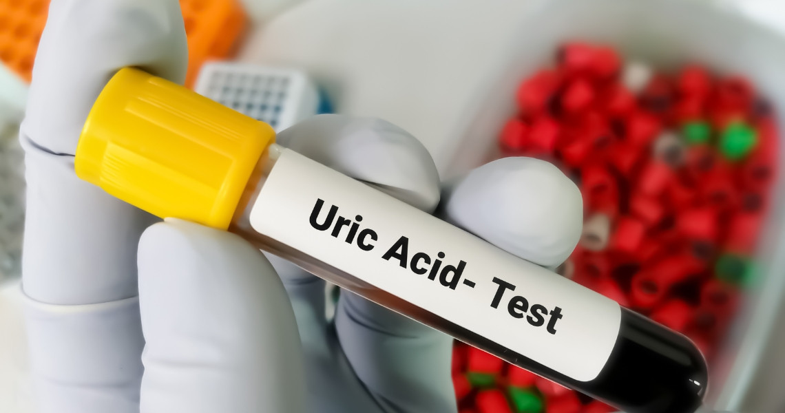 Mức Acid uric trong xét nghiệm máu thế nào là bình thường?