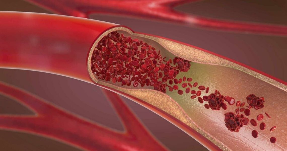 Bạn có nên lo lắng nếu mỡ triglyceride cao?