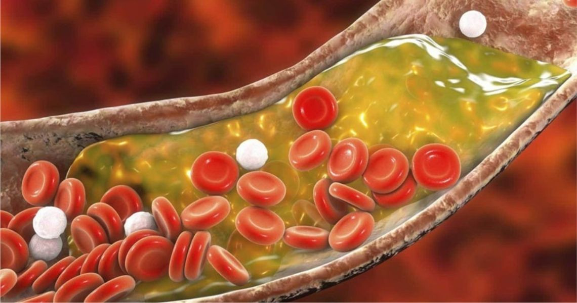 Điều gì làm tăng Cholesterol xấu LDL?