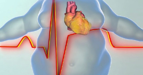 Béo phì khiến việc chẩn đoán và điều trị bệnh tim khó khăn hơn