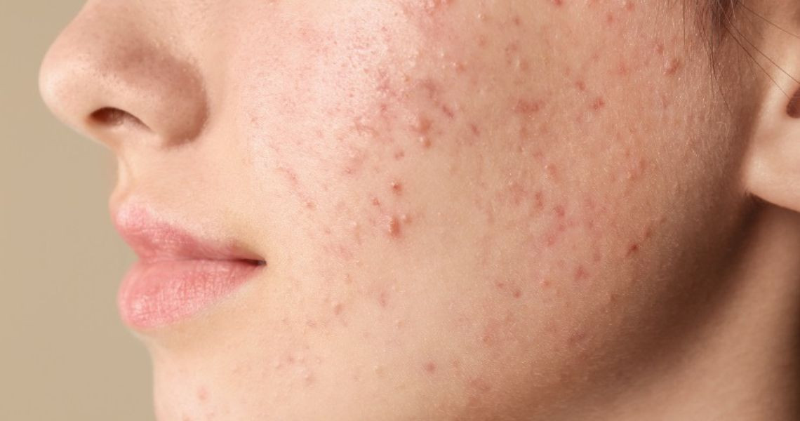 Làm gì để trẻ hóa da mặt sần sùi nhiều mụn?