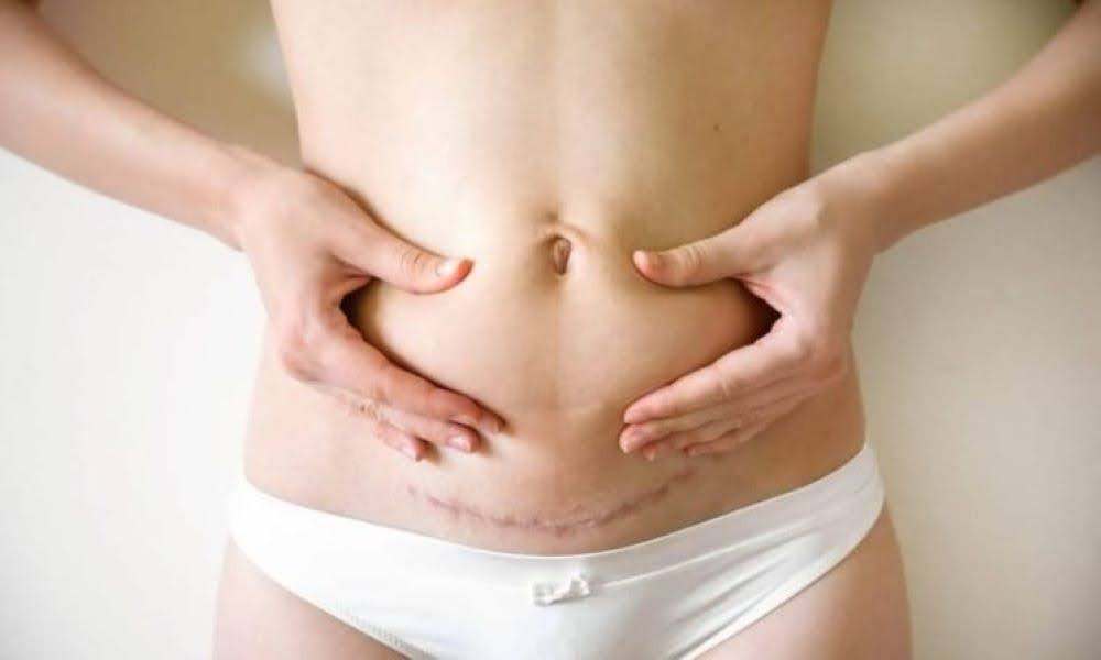 7 cách giảm mỡ bụng sau sinh mổ hiệu quả giúp mẹ bỉm lấy lại vóc dáng