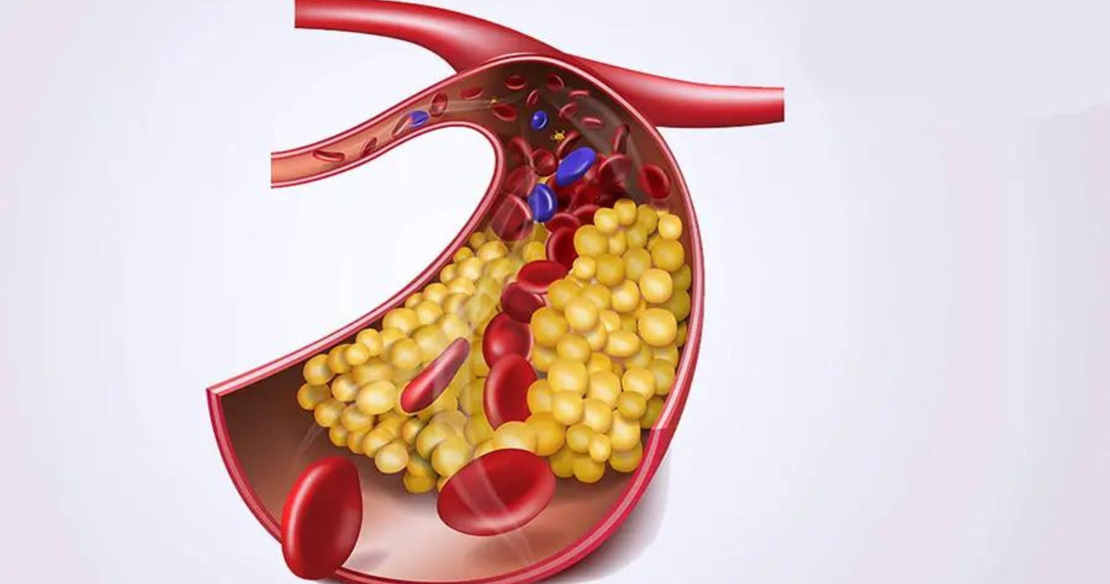 Tìm hiểu bệnh rối loạn chuyển hóa lipoprotein và tình trạng tăng lipid máu