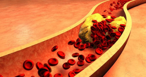 Bệnh mỡ máu cao có chữa khỏi được không?